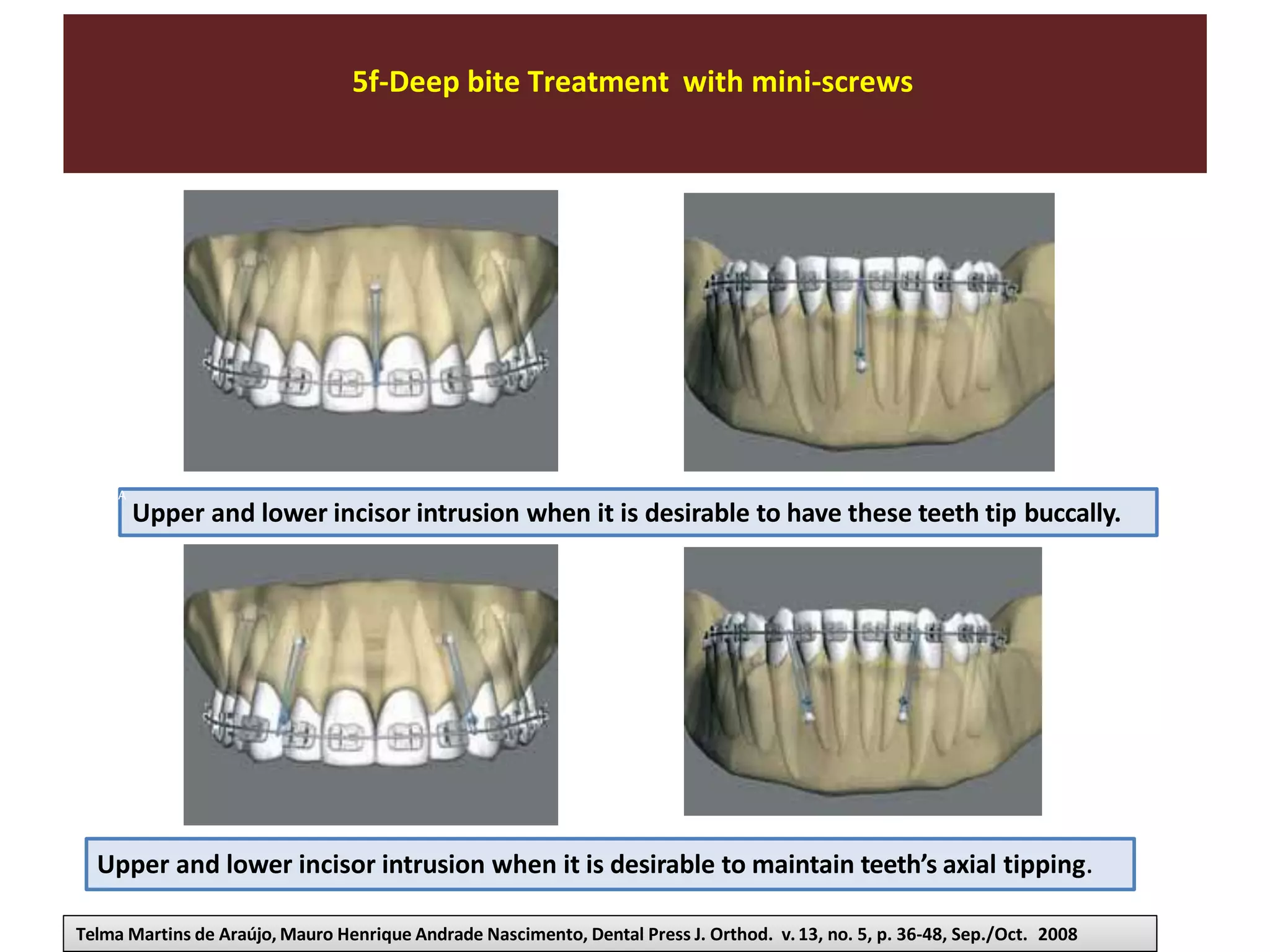 5f-Deep bite Treatment with mini-screws
Upper and lower incisor intrusion when it is desirable to have these teeth tip buccally.
Upper and lower incisor intrusion when it is desirable to maintain teeth’s axial tipping.
Telma Martins de Araújo, Mauro Henrique Andrade Nascimento, Dental Press J. Orthod. v.13, no. 5, p. 36-48, Sep./Oct. 2008
A
 
