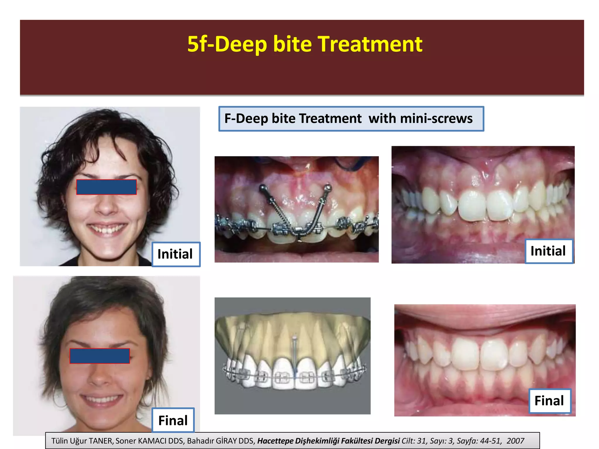 5f-Deep bite Treatment5f-Deep bite Treatment
F-Deep bite Treatment with mini-screws
Tülin Uğur TANER, Soner KAMACI DDS, Bahadır GİRAY DDS, Hacettepe Dişhekimliği Fakültesi Dergisi Cilt: 31, Sayı: 3, Sayfa: 44-51, 2007
Initial Initial
Final
Final
 