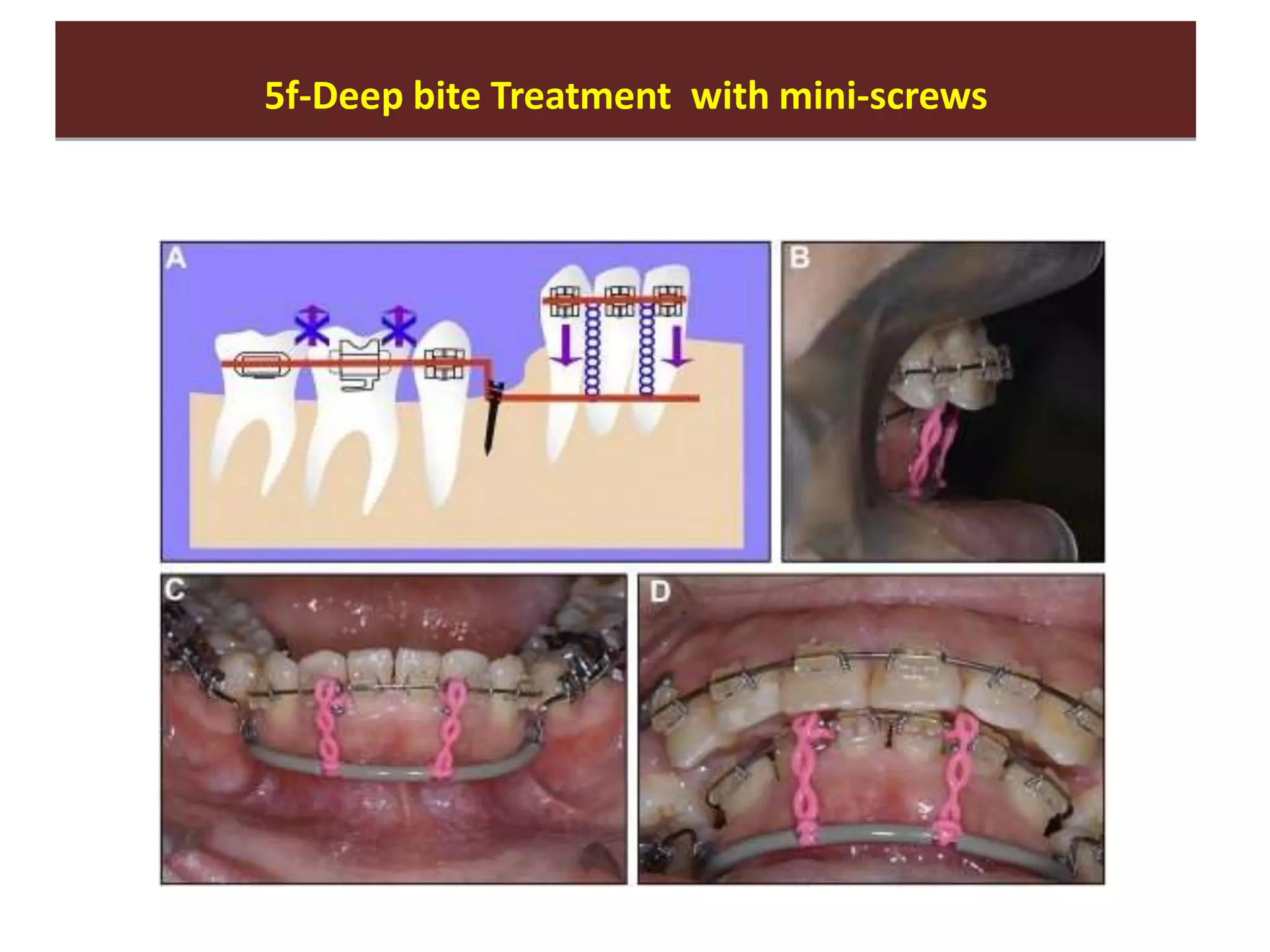 5f-Deep bite Treatment with mini-screws
5f-Deep bite Treatment with mini-screws
 