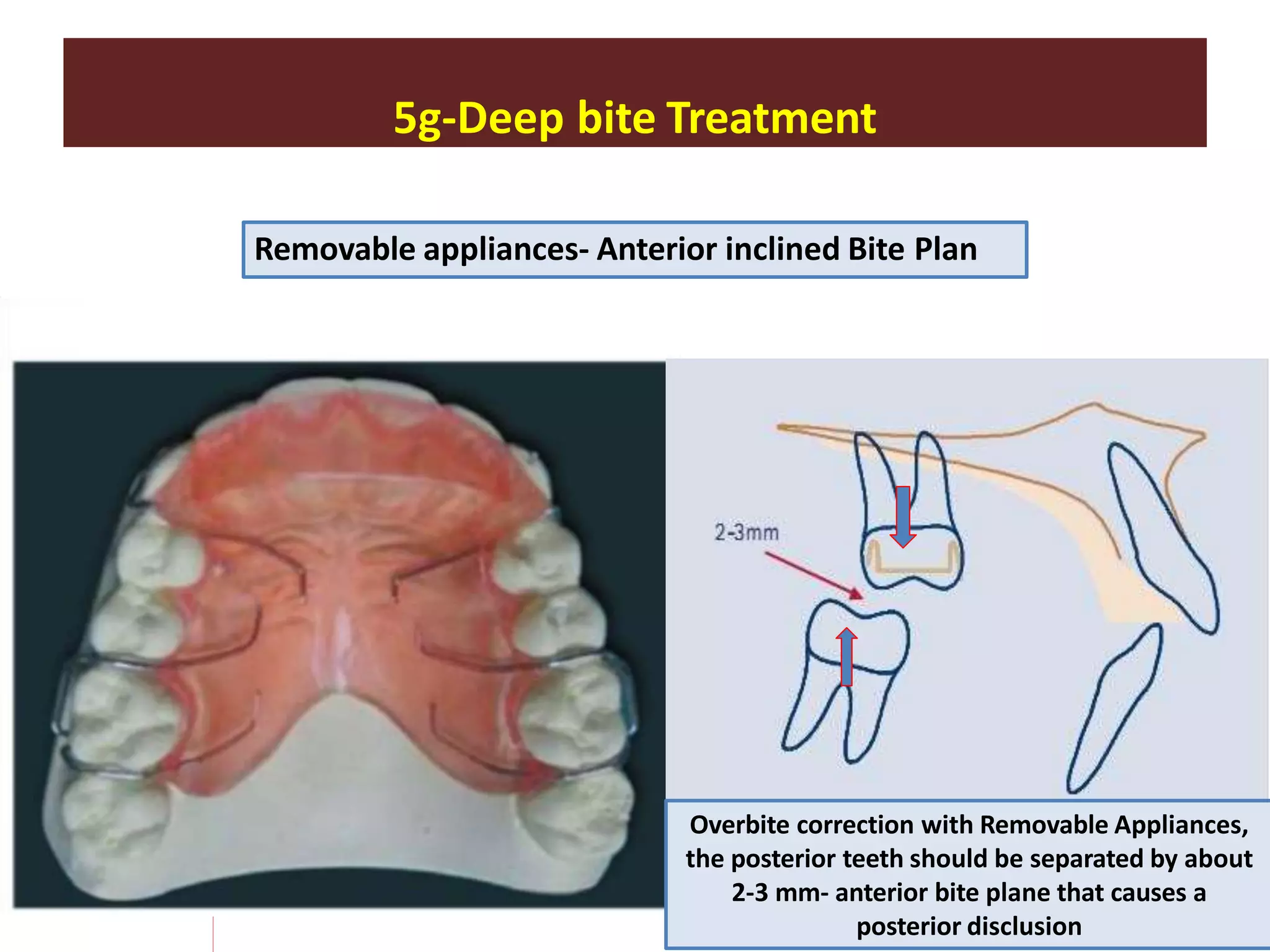 5g-Deep bite Treatment
Removable appliances- Anterior inclined Bite Plan
Overbite correction with Removable Appliances,
the posterior teeth should be separated by about
2-3 mm- anterior bite plane that causes a
posterior disclusion
 