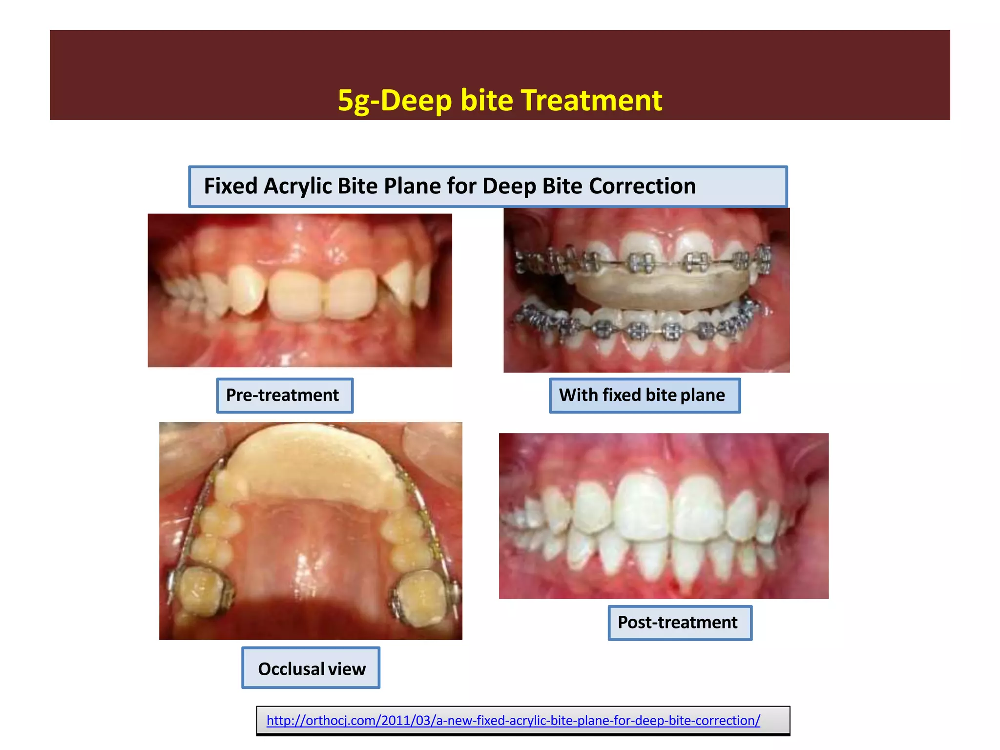 5g-Deep bite Treatment
http://orthocj.com/2011/03/a-new-fixed-acrylic-bite-plane-for-deep-bite-correction/
Pre-treatment With fixed biteplane
Occlusal view
Post-treatment
Fixed Acrylic Bite Plane for Deep Bite Correction
 