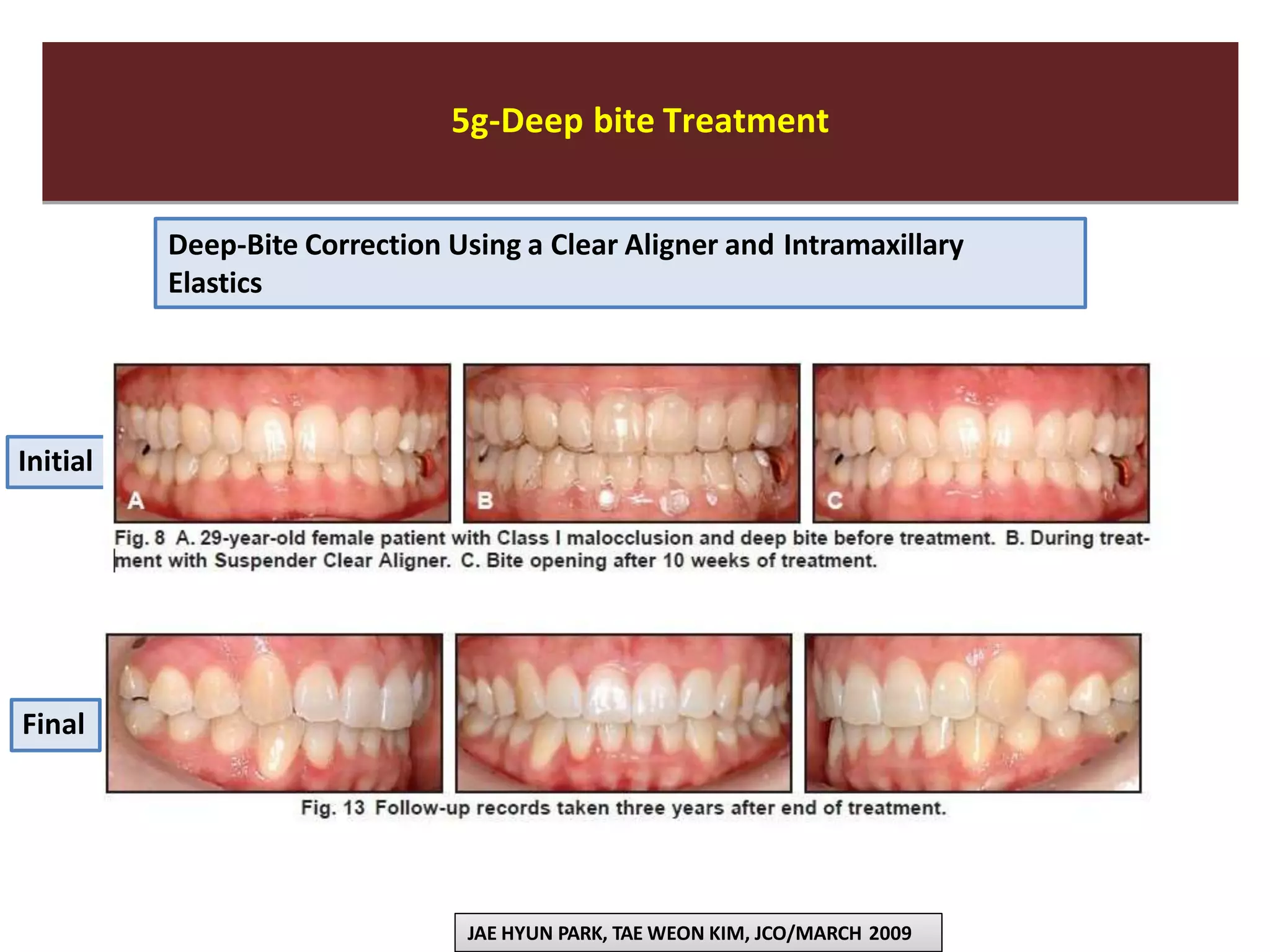 5g-Deep bite Treatment5g-Deep bite Treatment
Deep-Bite Correction Using a Clear Aligner and Intramaxillary
Elastics
JAE HYUN PARK, TAE WEON KIM, JCO/MARCH 2009
Initial
Final
 
