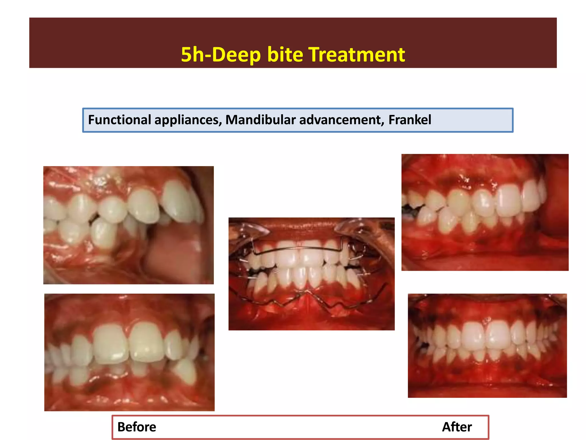 5h-Deep bite Treatment
Functional appliances, Mandibular advancement, Frankel
Before After
 