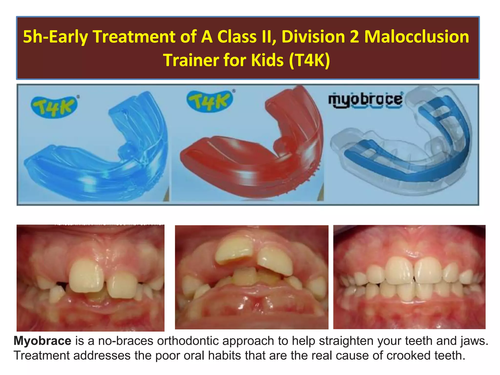 5h-Early Treatment of A Class II, Division 2 Malocclusion
Trainer for Kids (T4K)
ALHUSSAIN IBRAHIM ORTHODONTIST USA VIRGI
Myobrace is a no-braces orthodontic approach to help straighten your teeth and jaws.
Treatment addresses the poor oral habits that are the real cause of crooked teeth.
 