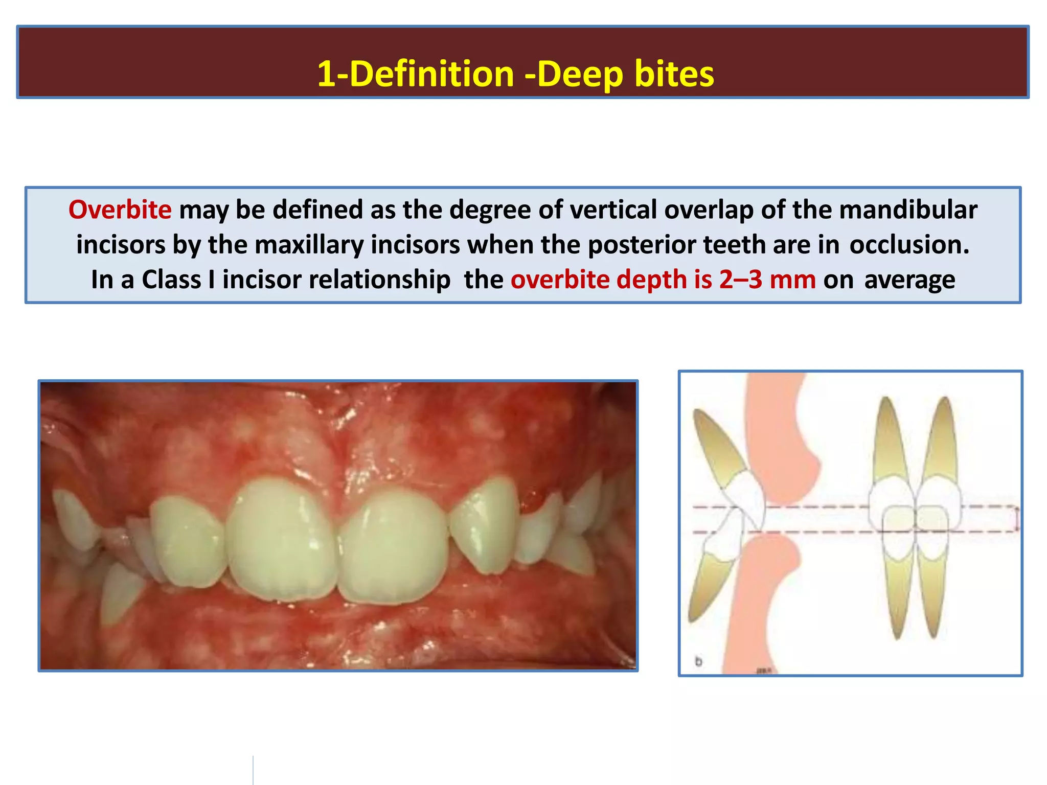 1-Definition -Deep bites
Overbite may be defined as the degree of vertical overlap of the mandibular
incisors by the maxillary incisors when the posterior teeth are in occlusion.
In a Class I incisor relationship the overbite depth is 2–3 mm on average
 