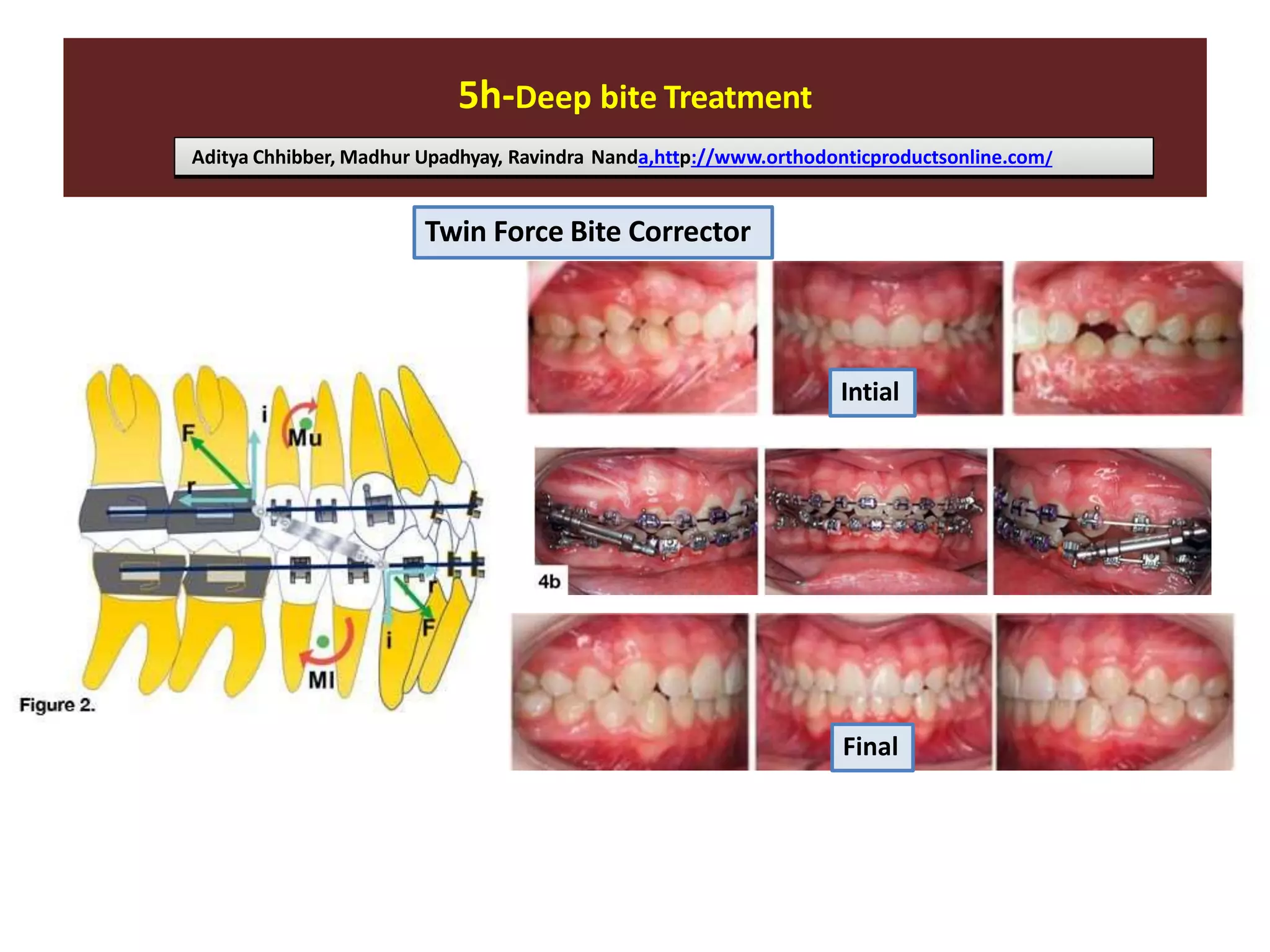 5h-Deep bite Treatment
Aditya Chhibber, Madhur Upadhyay, Ravindra Nanda,http://www.orthodonticproductsonline.com/
Twin Force Bite Corrector
Intial
Final
 