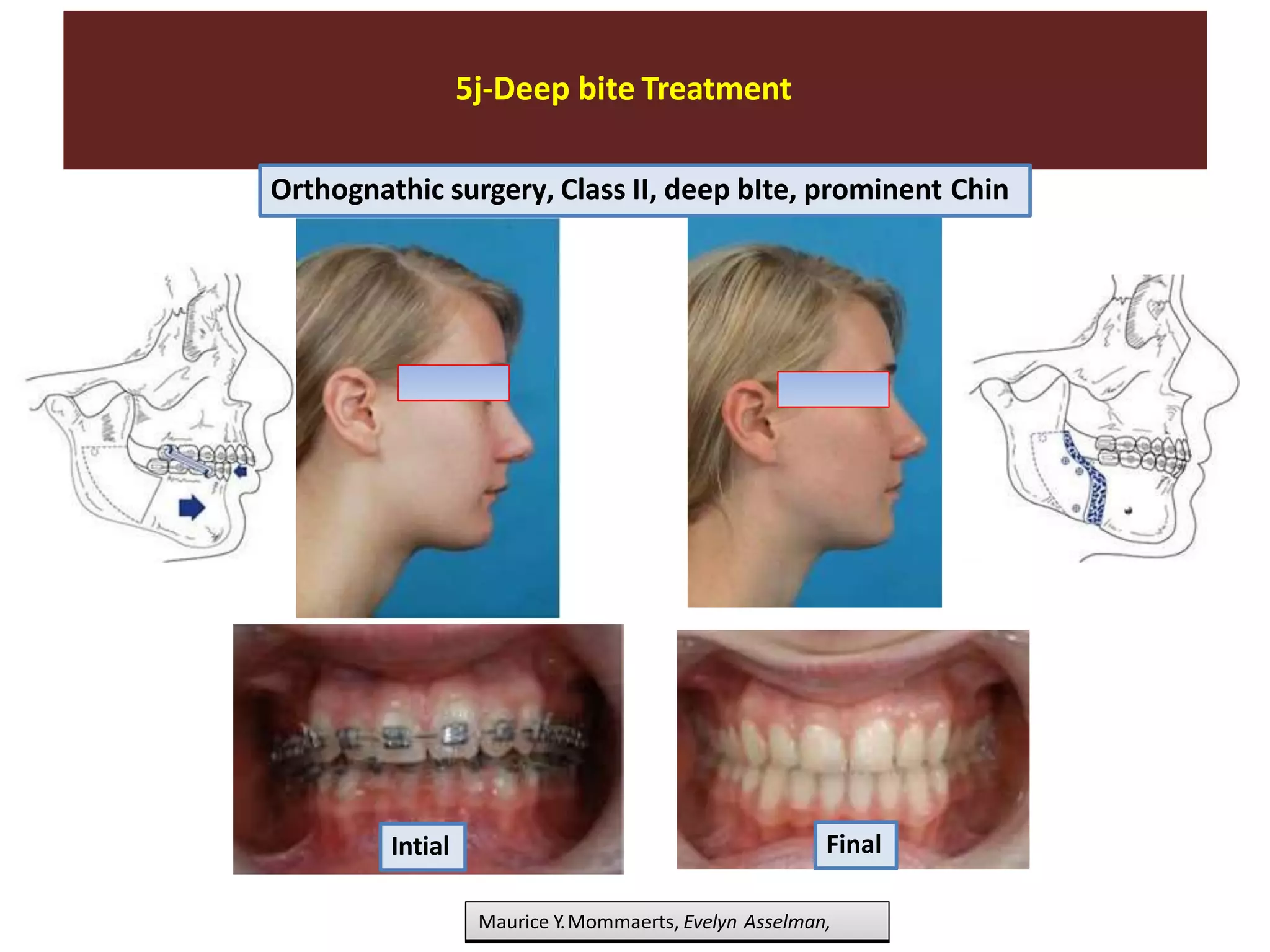 5j-Deep bite Treatment
Maurice Y.Mommaerts, Evelyn Asselman,
Orthognathic surgery, Class II, deep bIte, prominent Chin
Intial Final
 