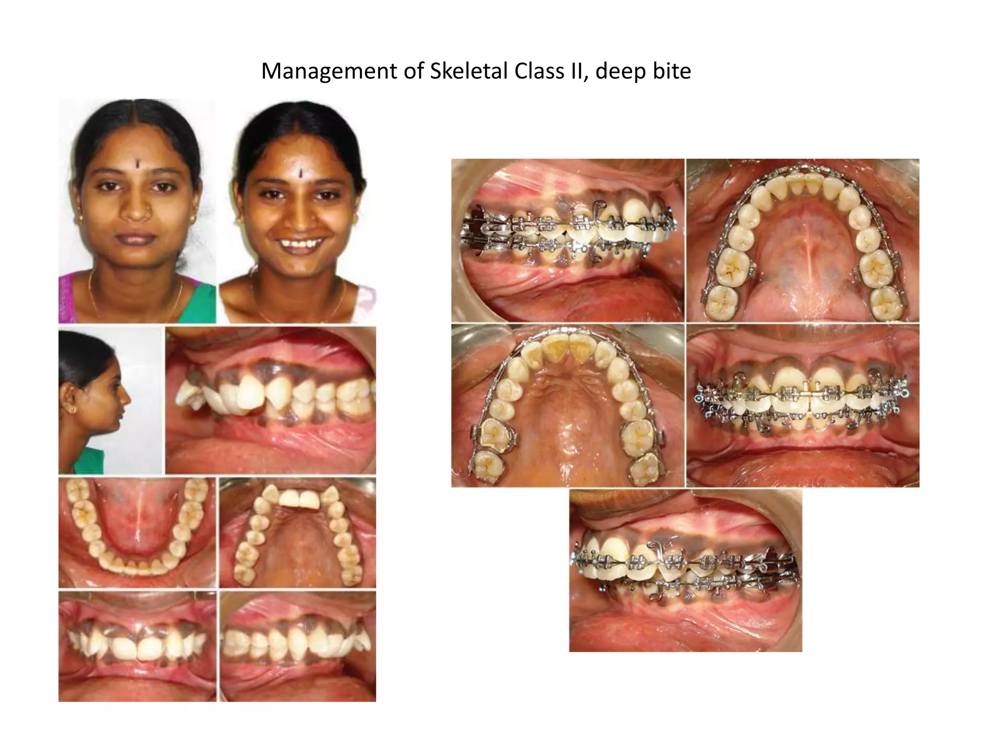Management of Skeletal Class II, deep bite
 