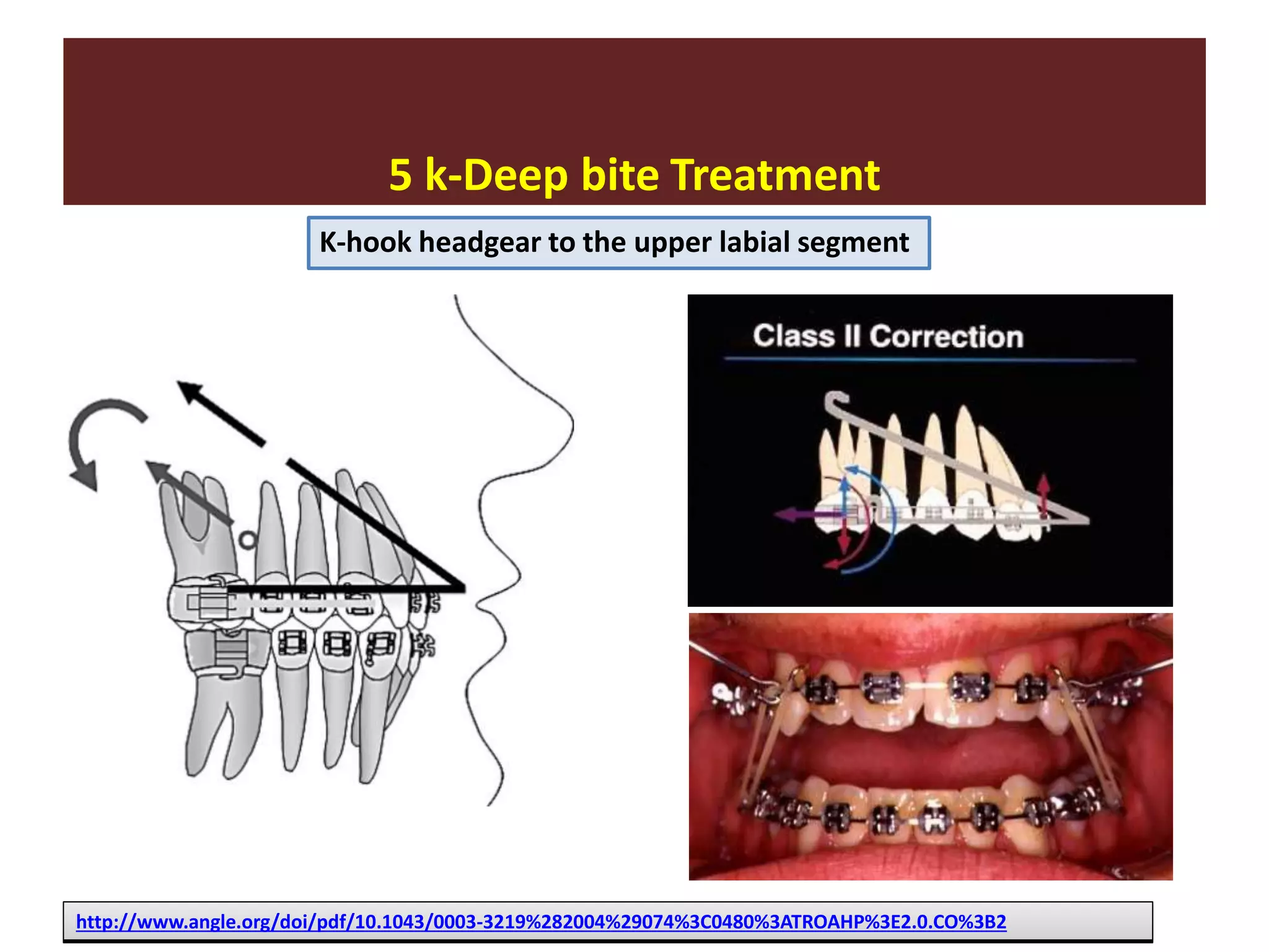 5 k-Deep bite Treatment
http://www.angle.org/doi/pdf/10.1043/0003-3219%282004%29074%3C0480%3ATROAHP%3E2.0.CO%3B2
K-hook headgear to the upper labial segment
 