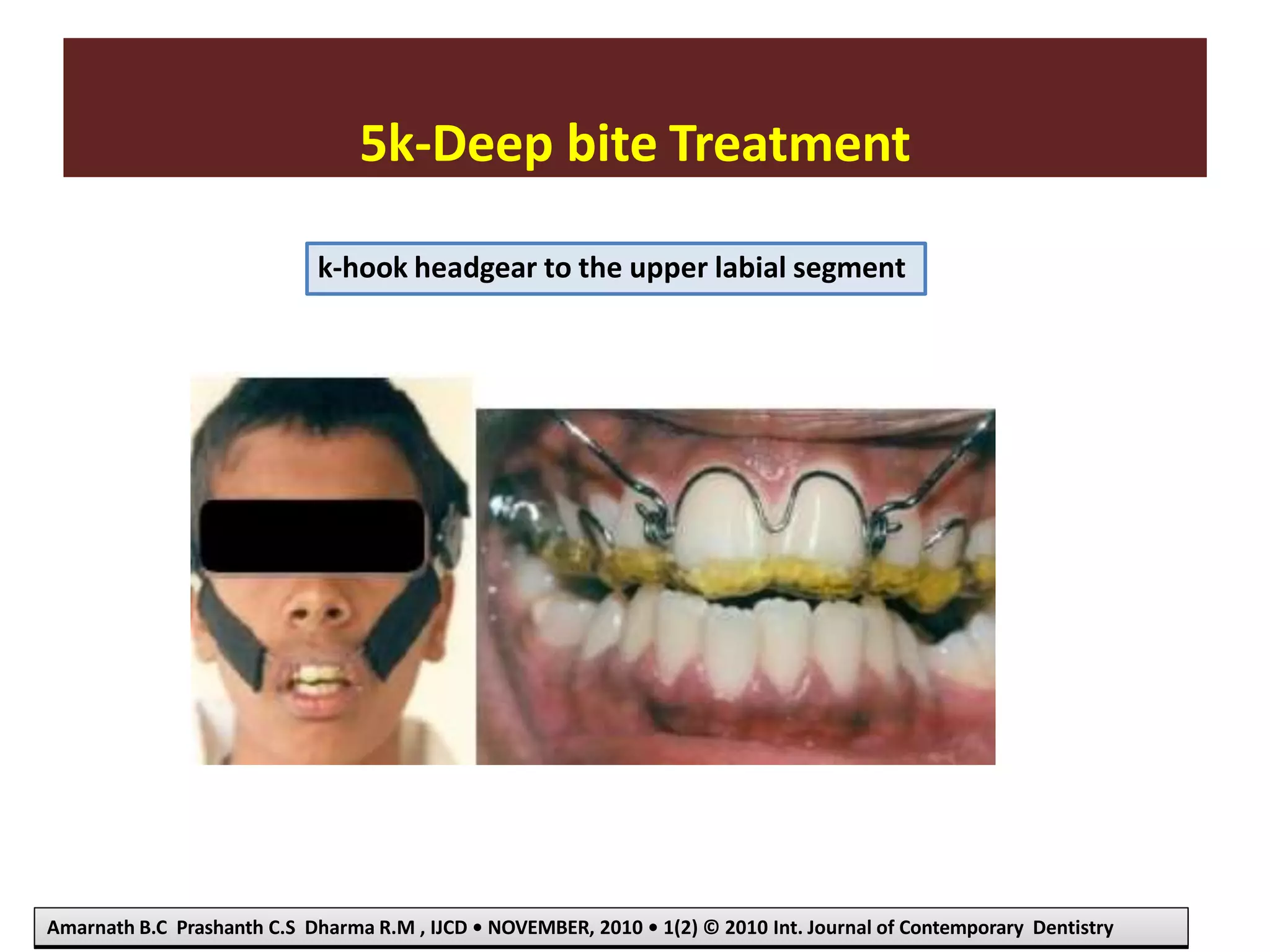 5k-Deep bite Treatment
Amarnath B.C Prashanth C.S Dharma R.M , IJCD • NOVEMBER, 2010 • 1(2) © 2010 Int. Journal of Contemporary Dentistry
k-hook headgear to the upper labial segment
 