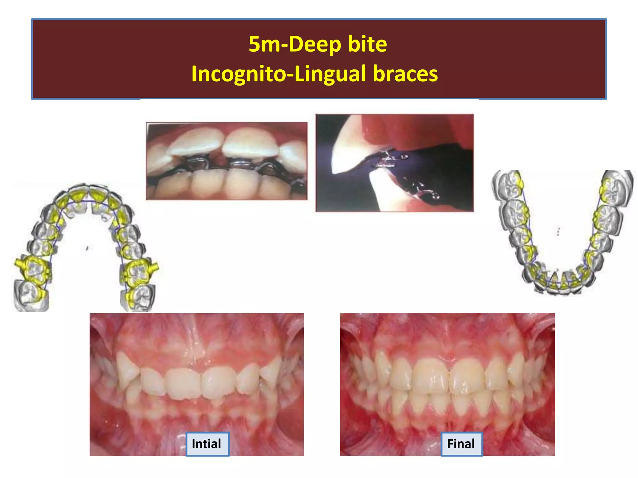 5m-Deep bite
Incognito-Lingual braces
Intial Final
 