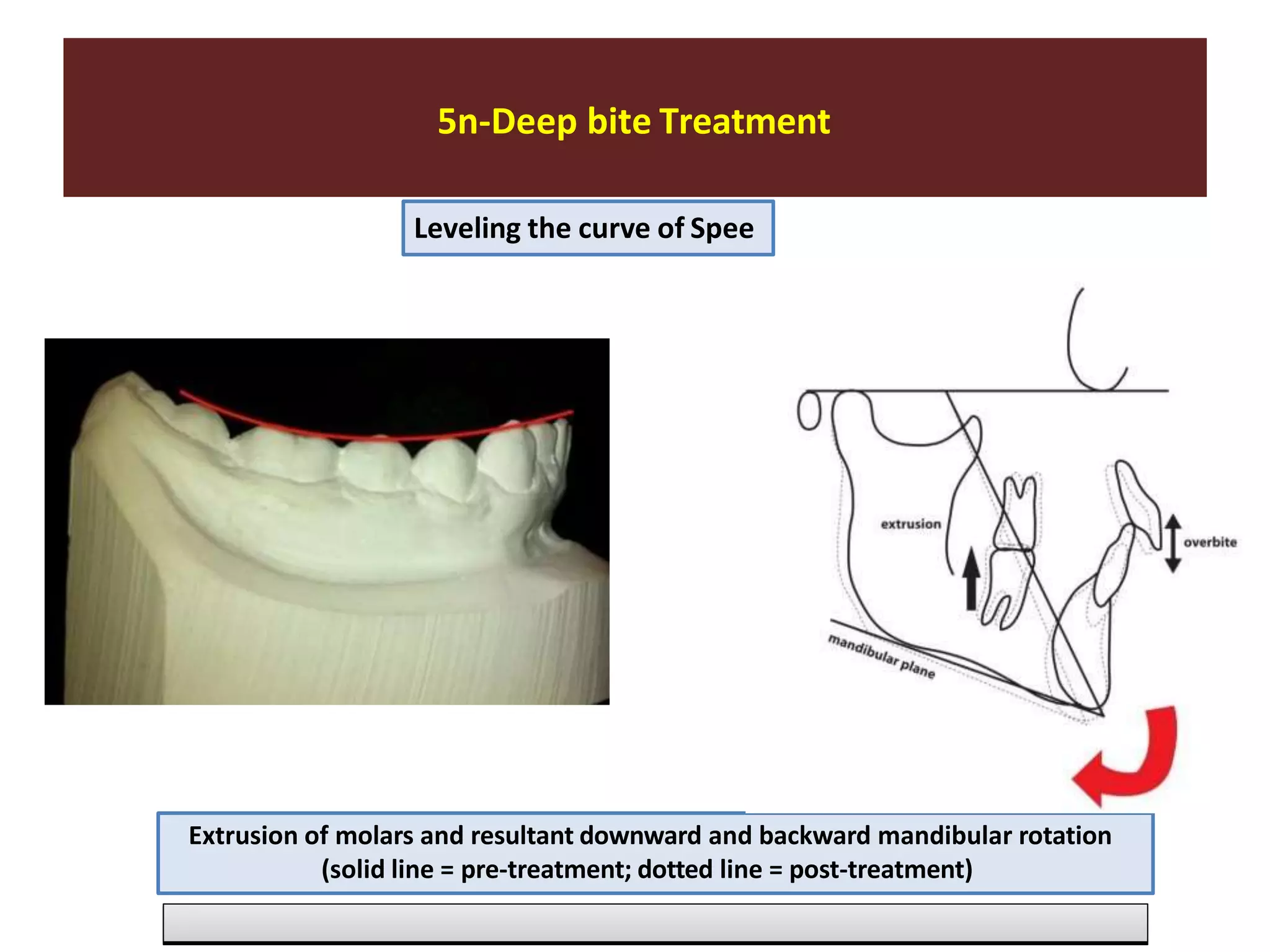 5n-Deep bite Treatment
Leveling the curve of Spee
Extrusion of molars and resultant downward and backward mandibular rotation
(solid line = pre-treatment; dotted line = post-treatment)
 