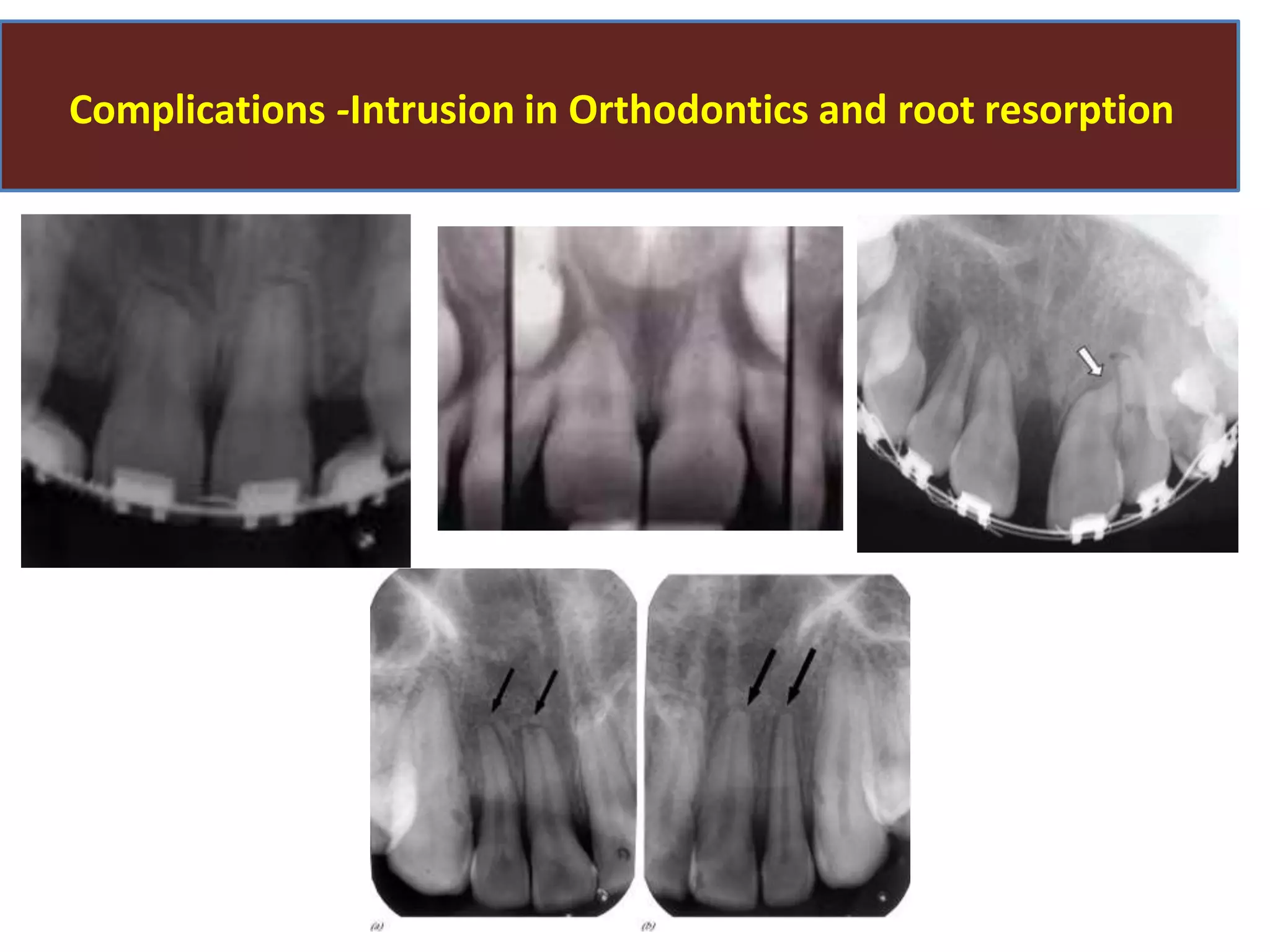 Complications -Intrusion in Orthodontics and root resorption
 