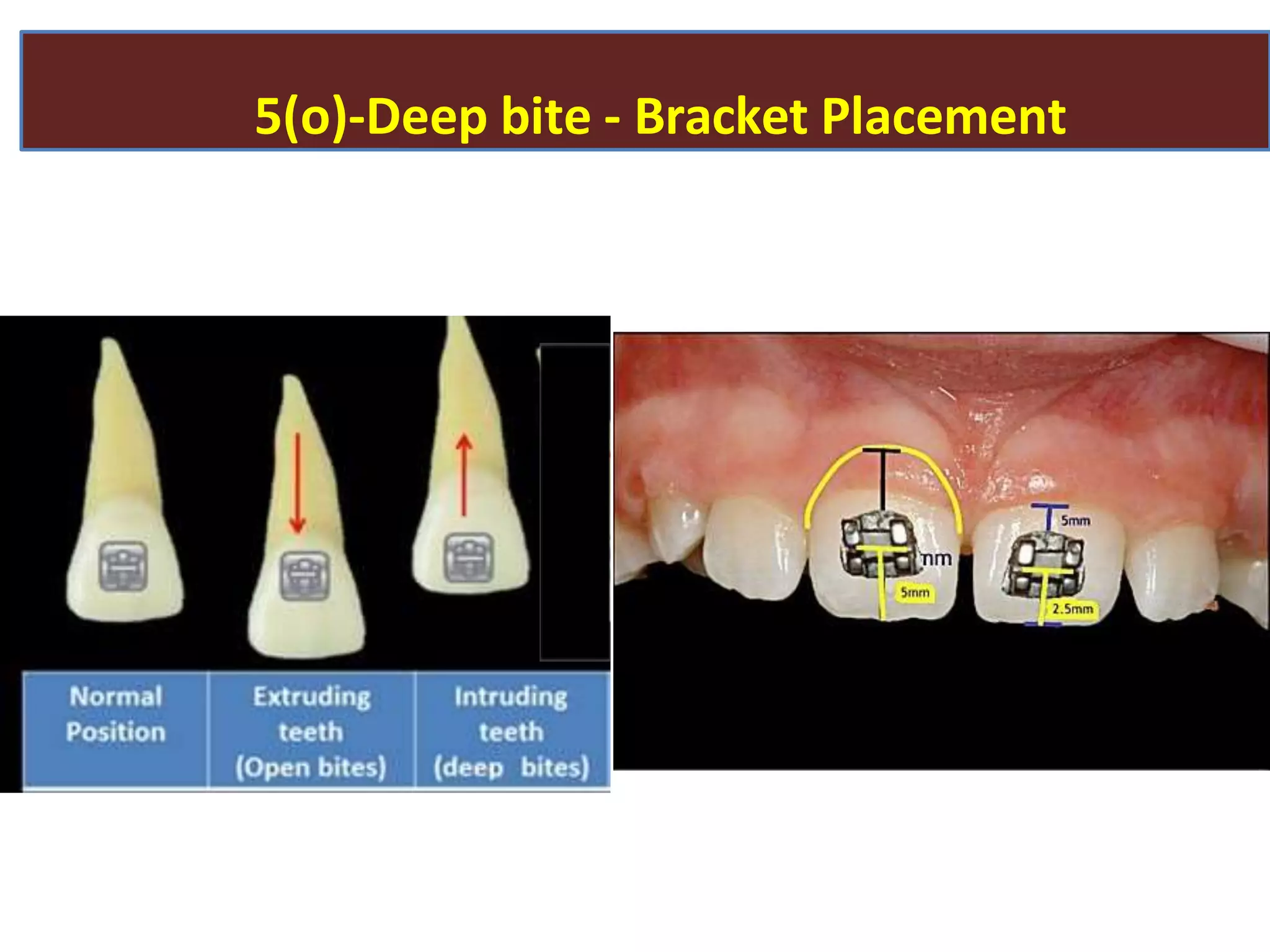 5(o)-Deep bite - Bracket Placement
 
