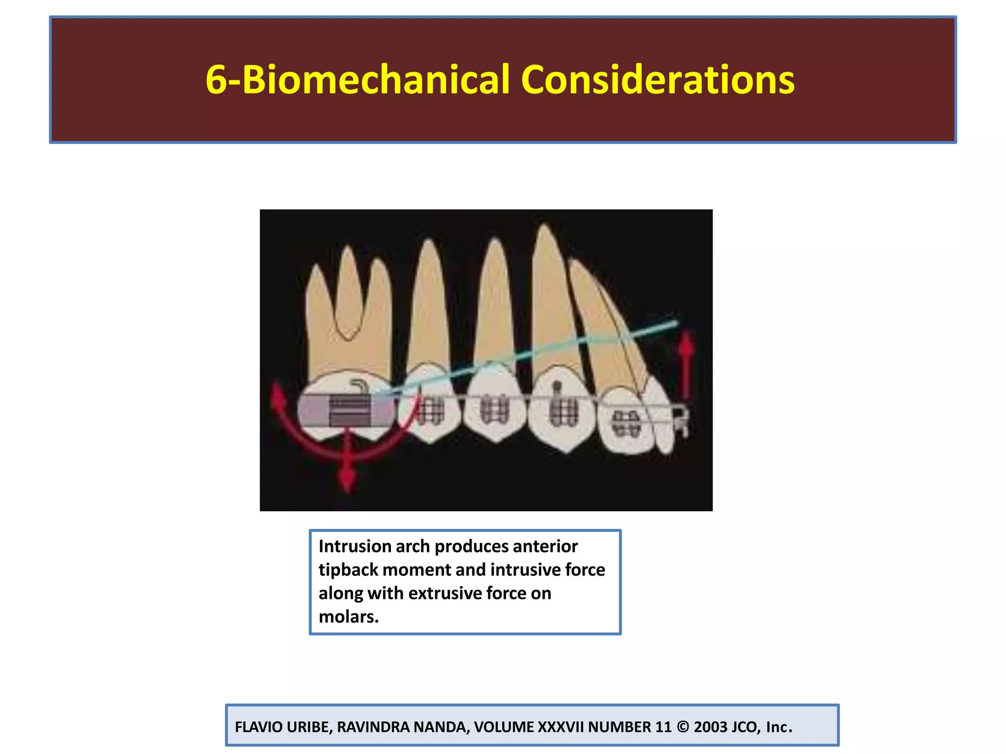 6-Biomechanical Considerations
FLAVIO URIBE, RAVINDRA NANDA, VOLUME XXXVII NUMBER 11 © 2003 JCO, Inc.
Intrusion arch produces anterior
tipback moment and intrusive force
along with extrusive force on
molars.
 