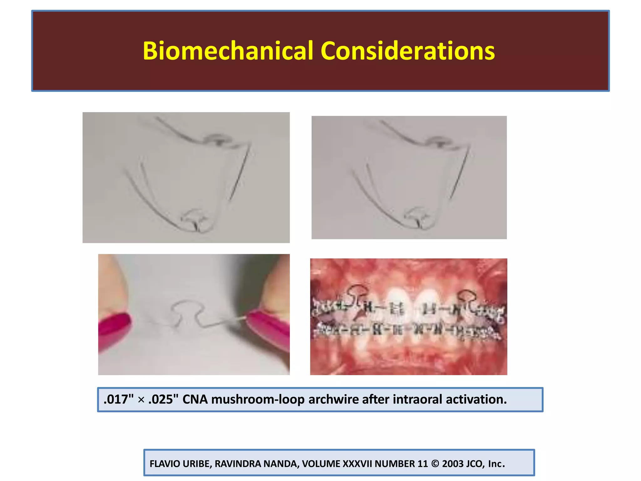 Biomechanical Considerations
FLAVIO URIBE, RAVINDRA NANDA, VOLUME XXXVII NUMBER 11 © 2003 JCO, Inc.
.017" × .025" CNA mushroom-loop archwire after intraoral activation.
 