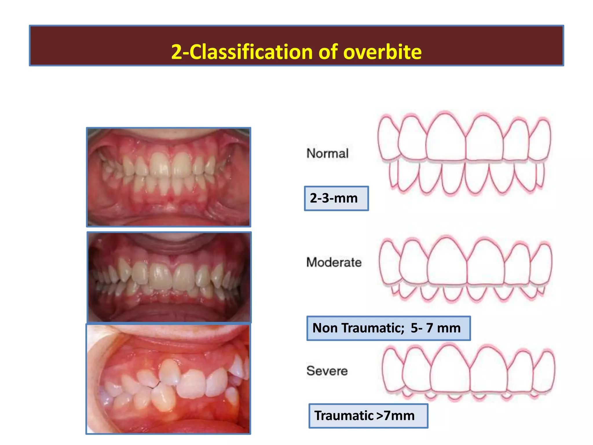 2-Classification of overbite
2-3-mm
Traumatic >7mm
Non Traumatic; 5- 7 mm
 