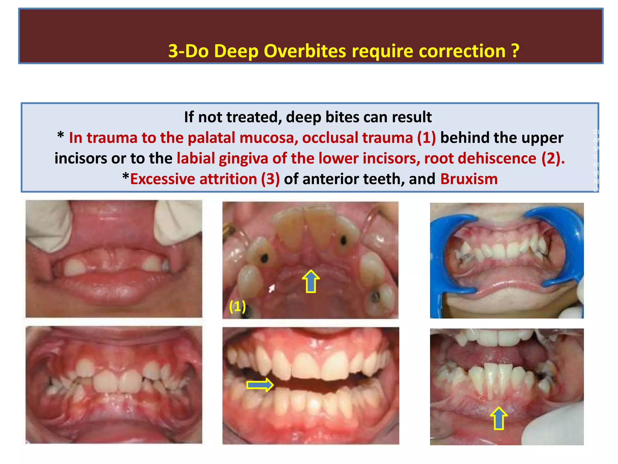 3-Do Deep Overbites require correction ?
If not treated, deep bites can result
* In trauma to the palatal mucosa, occlusal trauma (1) behind the upper
incisors or to the labial gingiva of the lower incisors, root dehiscence (2).
*Excessive attrition (3) of anterior teeth, and Bruxism
(1)
OU
AM
SA
D
M
MA
AB
LN
 