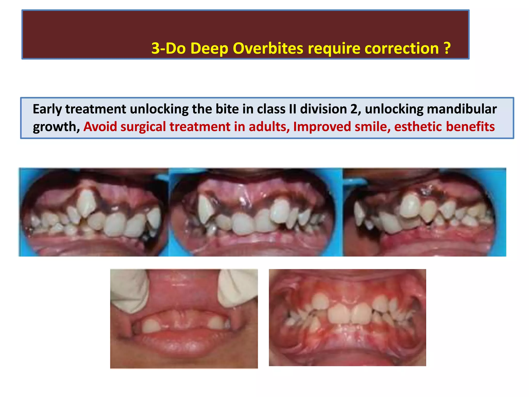 3-Do Deep Overbites require correction ?
Early treatment unlocking the bite in class II division 2, unlocking mandibular
growth, Avoid surgical treatment in adults, Improved smile, esthetic benefits
 