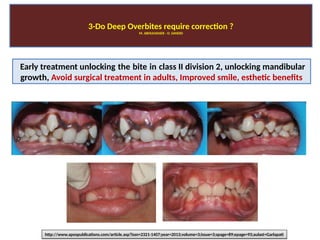 Deep bite malocclusions-M. ABOULNASER- Orthodontist, BUA, USA. O ...