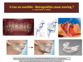 Facts About Deep Overbites, Schur Orthodontics
