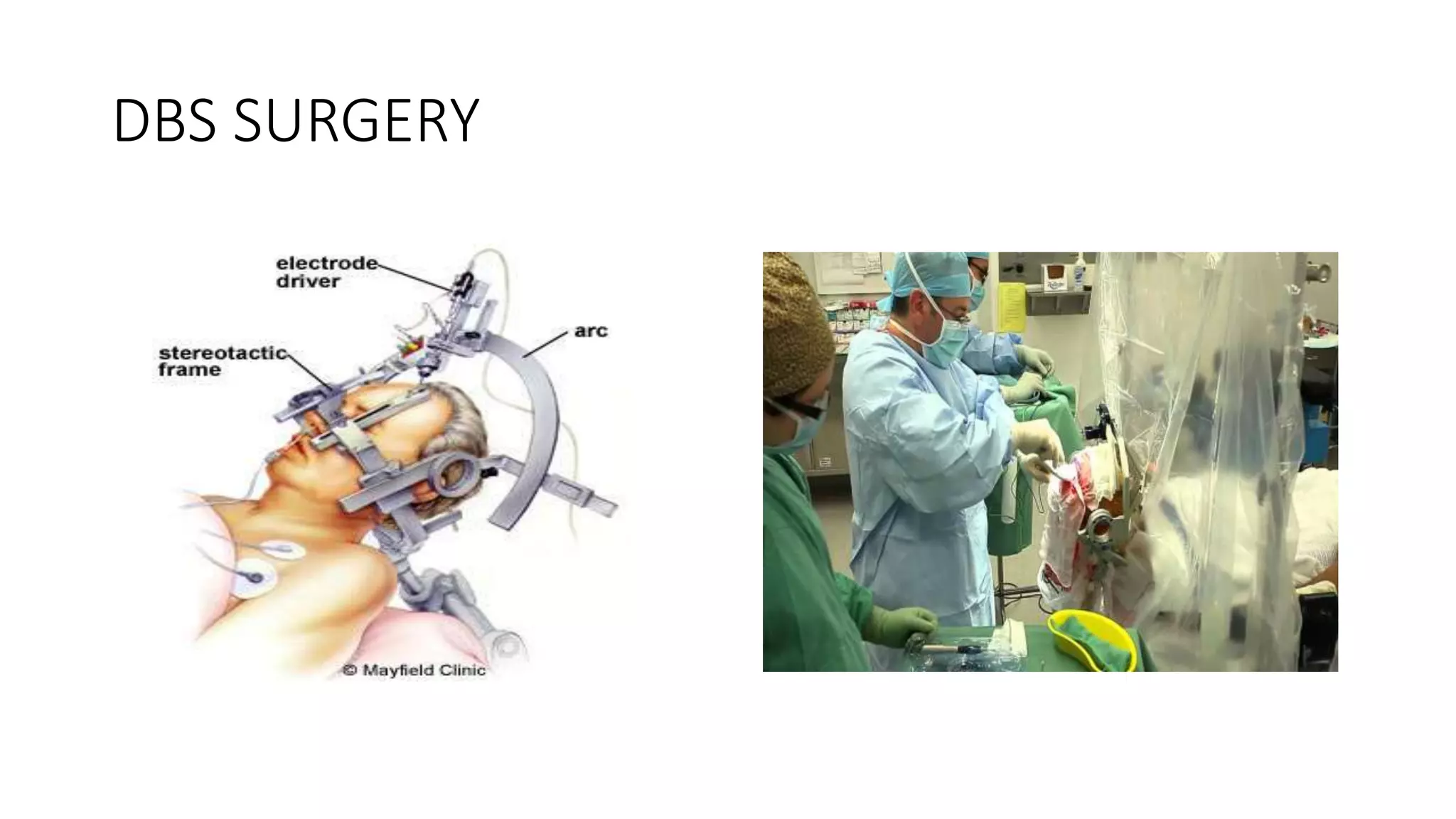 DBS SURGERY
 
