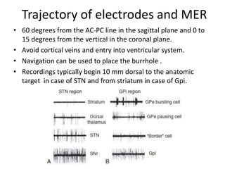 Trajectory of electrodes and MER
• 60 degrees from the AC-PC line in the sagittal plane and 0 to
15 degrees from the vertical in the coronal plane.
• Avoid cortical veins and entry into ventricular system.
• Navigation can be used to place the burrhole .
• Recordings typically begin 10 mm dorsal to the anatomic
target in case of STN and from striatum in case of Gpi.
 