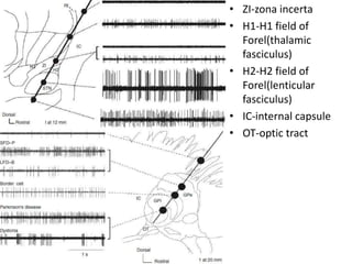• ZI-zona incerta
• H1-H1 field of
Forel(thalamic
fasciculus)
• H2-H2 field of
Forel(lenticular
fasciculus)
• IC-internal capsule
• OT-optic tract
H1
 