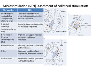 Microstimulation (STN) -assesment of collateral stimulation
Tip location Effect
1.Corticospinal
-corticobulbar
tract (anterior/
lateral to STN)
Tonic muscle contraction,
dysarthria-reposition lead or
reduce amplitude
2. Medial
lemniscus
(posteromedial to
STN)
Paresthesia-reposition the tip
or decrease amplitude
3. Fascicles of
3rd nerve
(inferomedial to
STN)
Diplopia-use upper electrode
or change to bipolar
electrode.
4.Hypothalamus Flushing, perspiration- usually
get habituated.
5. SNr Levodopa blocking effect,
depression,worsened akinesia
6.Red nucleus Dysequilibrium and gait ataxia
without limb ataxia
 