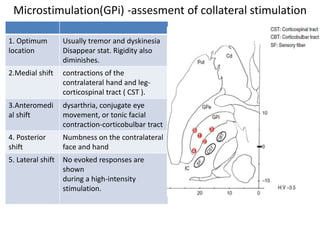 Microstimulation(GPi) -assesment of collateral stimulation
1. Optimum
location
Usually tremor and dyskinesia
Disappear stat. Rigidity also
diminishes.
2.Medial shift contractions of the
contralateral hand and leg-
corticospinal tract ( CST ).
3.Anteromedi
al shift
dysarthria, conjugate eye
movement, or tonic facial
contraction-corticobulbar tract
4. Posterior
shift
Numbness on the contralateral
face and hand
5. Lateral shift No evoked responses are
shown
during a high-intensity
stimulation.
 