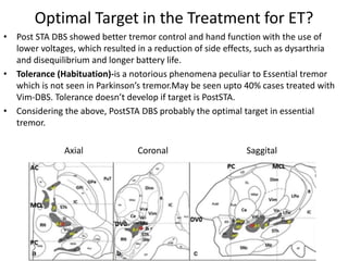 Optimal Target in the Treatment for ET?
• Post STA DBS showed better tremor control and hand function with the use of
lower voltages, which resulted in a reduction of side effects, such as dysarthria
and disequilibrium and longer battery life.
• Tolerance (Habituation)-is a notorious phenomena peculiar to Essential tremor
which is not seen in Parkinson’s tremor.May be seen upto 40% cases treated with
Vim-DBS. Tolerance doesn’t develop if target is PostSTA.
• Considering the above, PostSTA DBS probably the optimal target in essential
tremor.
Axial Coronal Saggital
 