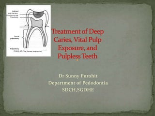 Dr Sunny Purohit
Department of Pedodontia
SDCH,SGDHE
 