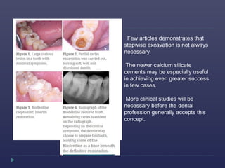 Few articles demonstrates that
stepwise excavation is not always
necessary.
The newer calcium silicate
cements may be especially useful
in achieving even greater success
in few cases.
More clinical studies will be
necessary before the dental
profession generally accepts this
concept.
 
