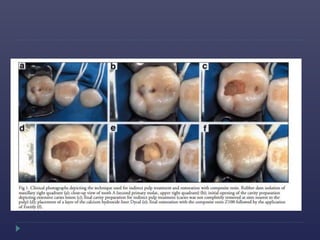 Deep carious lesions