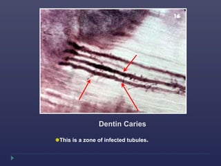 Dentin Caries
This is a zone of infected tubules.
 