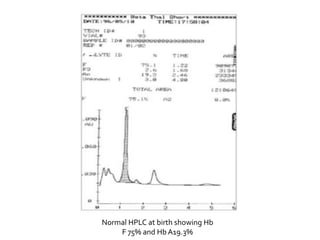Normal HPLC at birth showing Hb
F 75% and Hb A19.3%
 