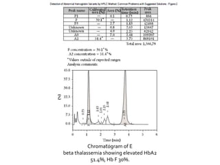 Chromatogram of E
beta thalassemia showing elevated HbA2
51.4%, Hb F 30%.
 