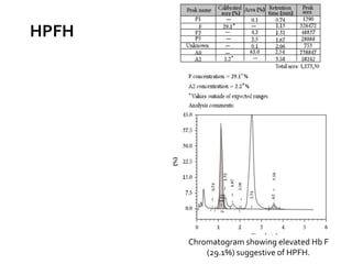 Chromatogram showing elevated Hb F
(29.1%) suggestive of HPFH.
HPFH
 