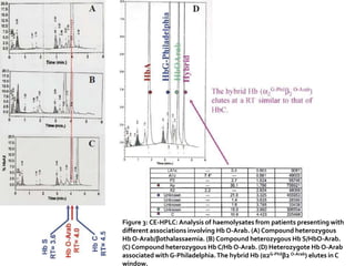 Figure 3: CE-HPLC: Analysis of haemolysates from patients
presenting with different associations involving Hb O-Arab.
(A) Compound heterozygous Hb O-Arab/β0thalassaemia.
(B) Compound heterozygous Hb S/HbO-Arab. (C) Compound
heterozygous Hb C/Hb O-Arab. (D) Heterozygote Hb O-Arab
associated with G-Philadelphia.The hybrid Hb (α2G-Philβ2 O-
Arab) elutes in C window.
Figure 3: CE-HPLC: Analysis of haemolysates from patients presenting with
different associations involving Hb O-Arab. (A) Compound heterozygous
Hb O-Arab/β0thalassaemia. (B) Compound heterozygous Hb S/HbO-Arab.
(C) Compound heterozygous Hb C/Hb O-Arab. (D) Heterozygote Hb O-Arab
associated with G-Philadelphia.The hybrid Hb (α2G-Philβ2 O-Arab) elutes in C
window.
 