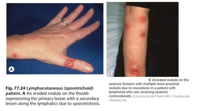 Deep fungal infection.pptx | Skin and Dermatology | Diseases and Conditions