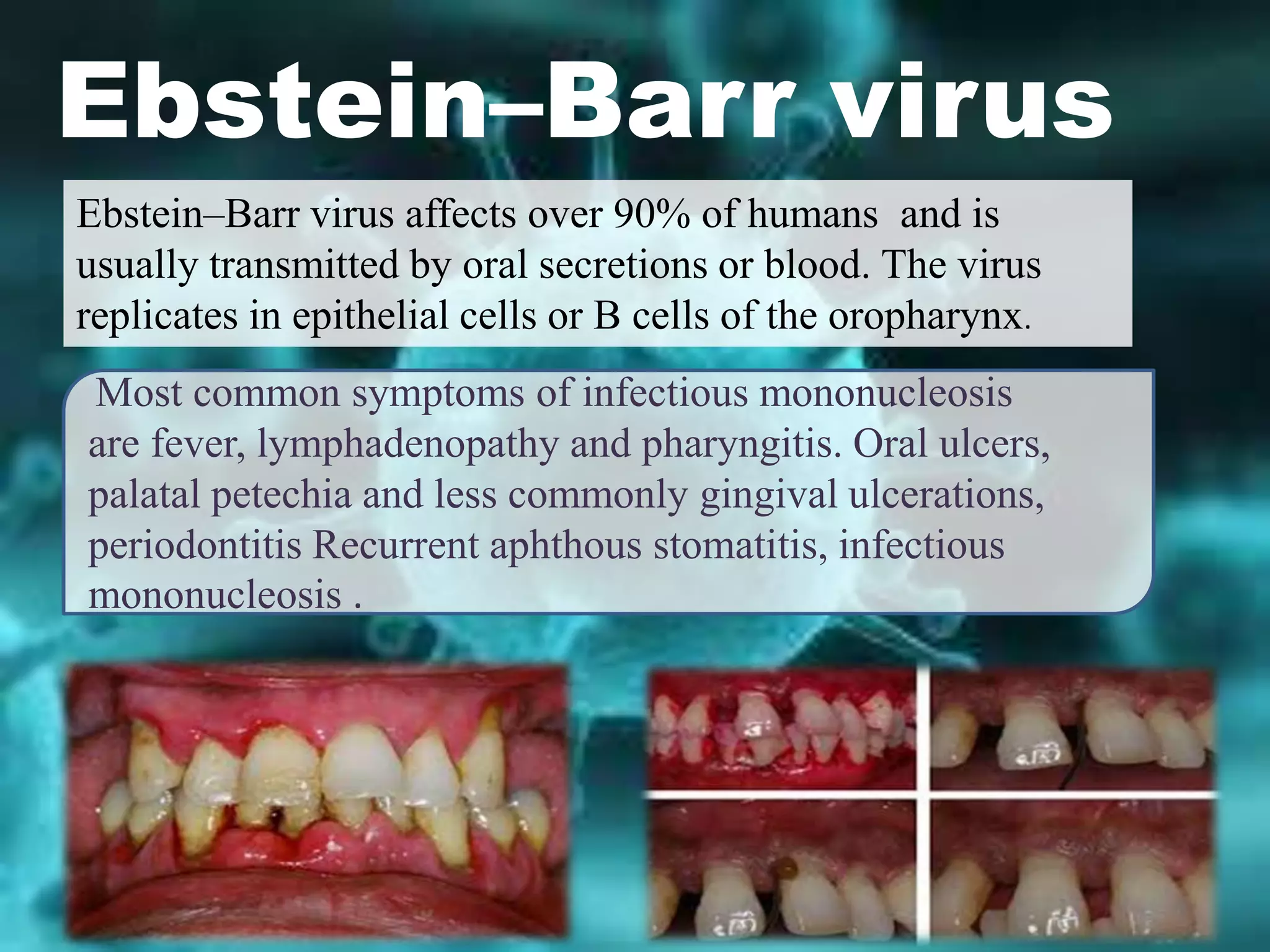 viruses in periodontal disease | PPTX