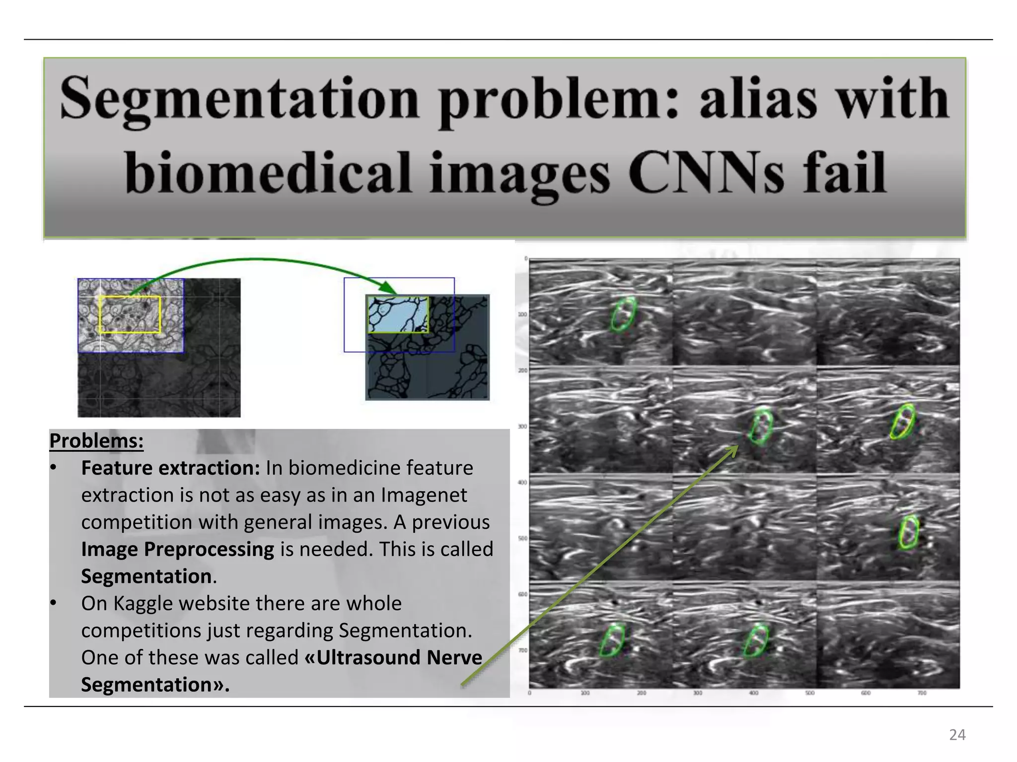 24
Problems:
• Feature extraction: In biomedicine feature
extraction is not as easy as in an Imagenet
competition with general images. A previous
Image Preprocessing is needed. This is called
Segmentation.
• On Kaggle website there are whole
competitions just regarding Segmentation.
One of these was called «Ultrasound Nerve
Segmentation».
 