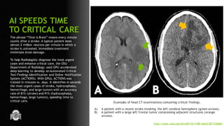 67
The phrase “Time is Brain” means every minute
counts after a stroke. A typical patient loses
almost 2 million neurons per minute in which a
stroke is untreated. Immediate treatment
minimizes brain damage.
To help Radiologists diagnose the most urgent
cases and enhance critical care, the OSU
Department of Radiology used GPU-accelerated
deep learning to develop an Automated Critical
Test-Findings Identification and Online Notification
System (ACTIONS). With GPUs, ACTIONS was
trained in minutes vs. days. It identifies in seconds
the most urgent cases of stroke, hydrocephalus,
hemorrhage, and large tumors with an accuracy
rate of 81% (stroke) and 91% (hydrocephalus,
hemorrhage, large tumors), speeding time to
critical care.
AI SPEEDS TIME
TO CRITICAL CARE
Examples of head CT examinations containing critical findings.
A) A patient with a recent stroke involving the left cerebral hemisphere (green arrows).
B) A patient with a large left frontal tumor compressing adjacent structures (orange
arrows).
http://pubs.rsna.org/doi/pdf/10.1148/radiol.2017162664
 