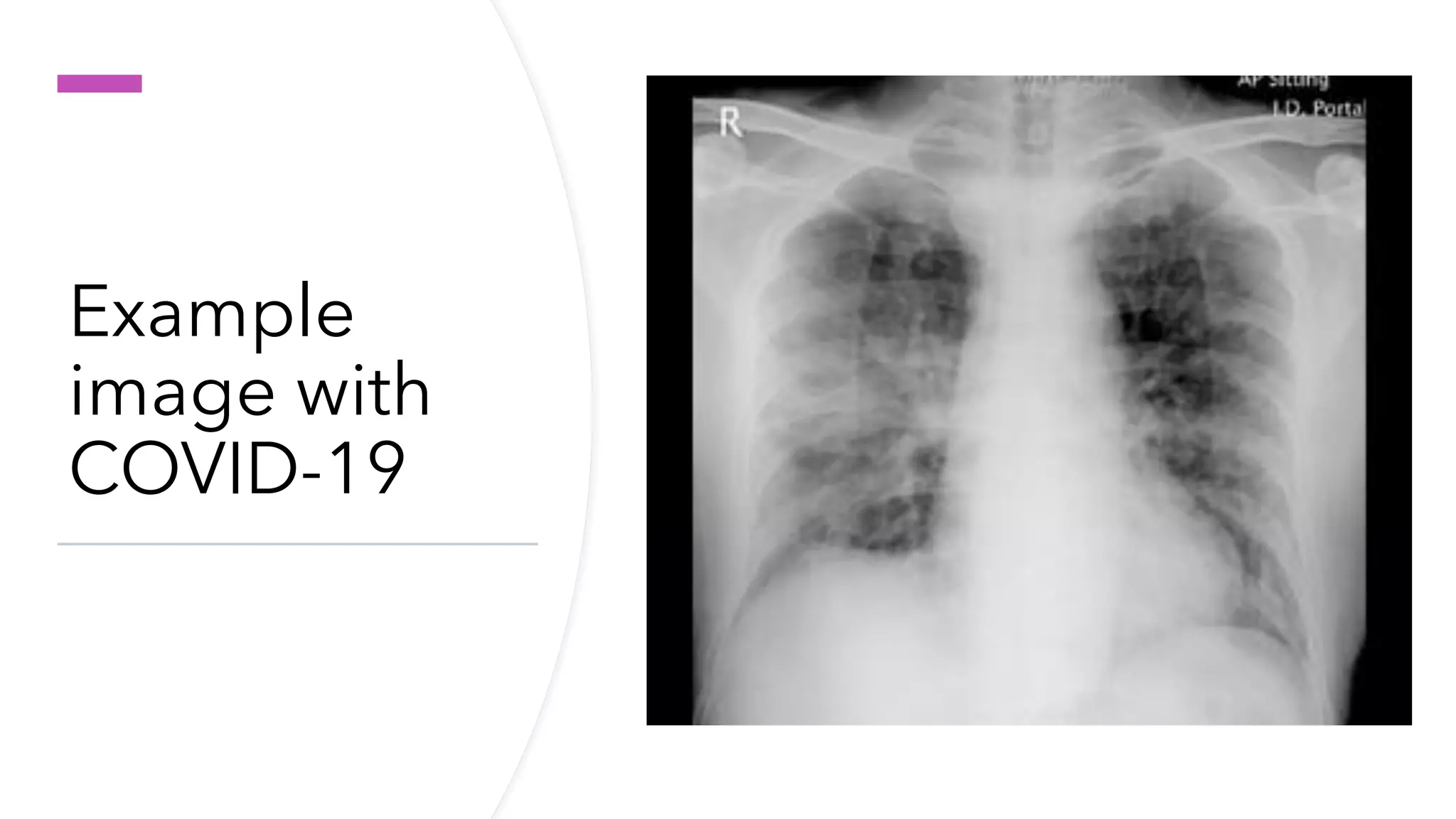 Deep learning for covid 19 detection on chest x-ray | PPT