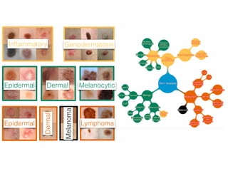 Speciﬁcity,%
Sensitivity, %
AUC of 96%
Carcinoma:
135 images
Dermatologists (25)
Algorithm vs Dermatologists
 