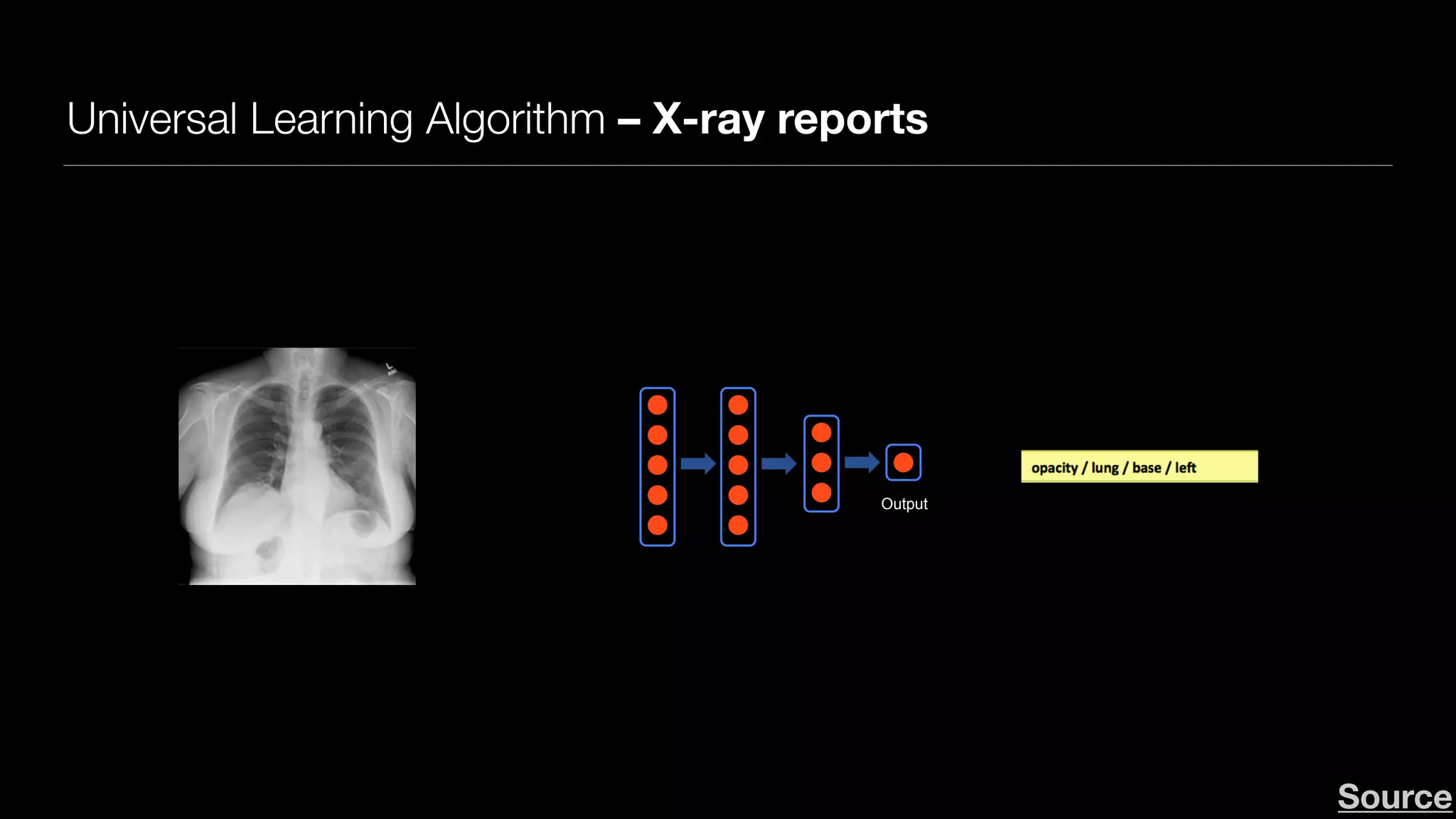 Universal Learning Algorithm – X-ray reports
Andrew NgAndrew Ng
Neurons in the brain
Output
Deep Learning: Neural network
Source
 