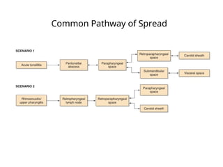 Common Pathway of Spread
 