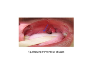 Fig. showing Peritonsillar abscess
 