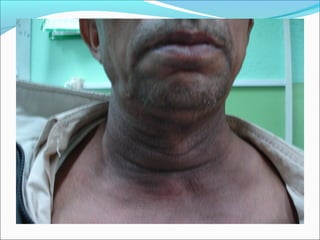 Deep neck space infections