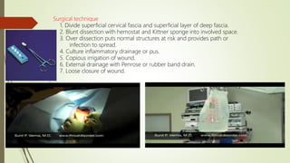 Surgical technique
1. Divide superficial cervical fascia and superficial layer of deep fascia.
2. Blunt dissection with hemostat and Kittner sponge into involved space.
3. Over dissection puts normal structures at risk and provides path or
infection to spread.
4. Culture inflammatory drainage or pus.
5. Copious irrigation of wound.
6. External drainage with Penrose or rubber band drain.
7. Loose closure of wound.
 